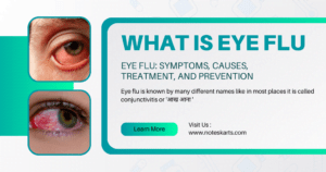 Read more about the article Eye Flu: Symptoms, Causes, Treatment, and Prevention